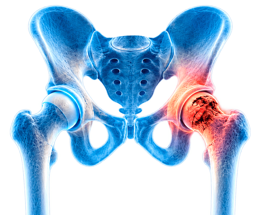 Terapia celular para necrosis avascular